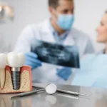 Implantes dentales: what to expect