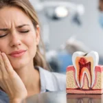 When Do You Need a Root Canal?
