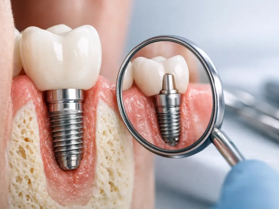 A Clear Guide to Dental Implant Healing