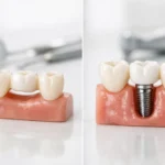 Puente o implante: Which Option Fits You?