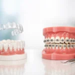 Clear Aligners vs Braces: Which Fits You?