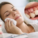 Recuperacion tras cirugia periodontal: Healing