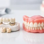 Dental Bridge vs Denture: Which Is Right?
