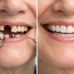 Implant Case Before and After: What Changes?
